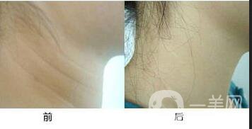 熱瑪吉去頸紋*果,熱瑪吉去頸紋