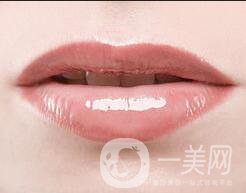 唇腭裂修復(fù)術(shù)后護理,唇腭裂修復(fù)