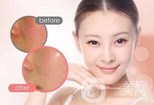 果酸嫩膚維持時(shí)間