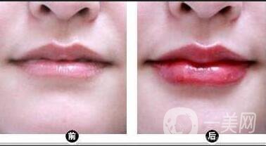 自體脂肪豐唇*果,自體脂肪豐唇