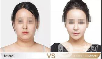 北京光纖溶脂去雙下巴多少錢,光纖溶脂去雙下巴多少錢