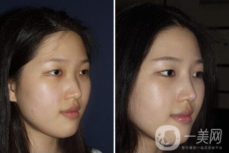 上海肋軟骨隆鼻多少錢(qián),肋軟骨隆鼻多少錢(qián),肋軟骨隆鼻