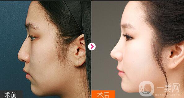 膨體墊下巴感染癥狀,膨體墊下巴