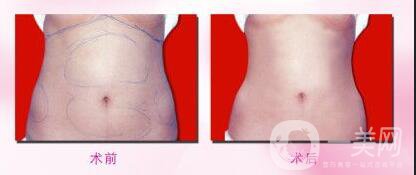 溶脂減肥多少錢