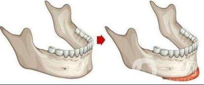 膨體墊下巴感染的癥狀有哪些？詳細介紹一覽
