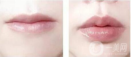 玻尿酸豐唇珠,玻尿酸豐唇珠注意事項(xiàng)