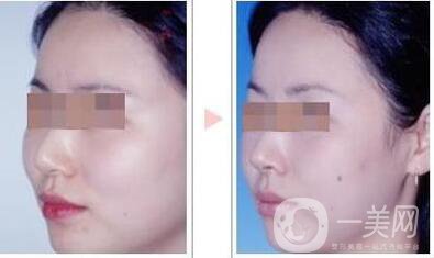 深圳顴弓降低術(shù)多少錢