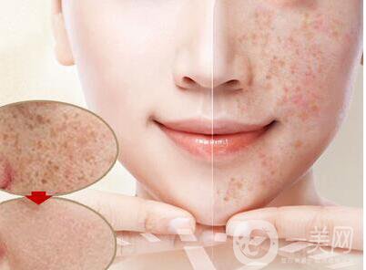 激光去曬斑術(shù)后護(hù)理