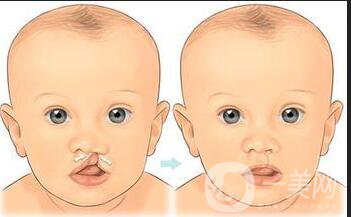 唇腭裂修復(fù)*果