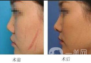 手術(shù)祛疤術(shù)后護(hù)理