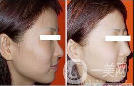 E光嫩膚維持時(shí)間