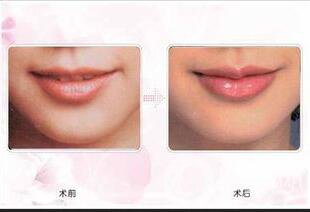 自體脂肪豐唇副作用,自體脂肪豐唇