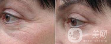 廣東玻尿酸去魚(yú)尾紋一般多少錢(qián)