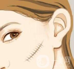 激光祛疤*果怎么樣？有什么優(yōu)勢