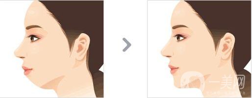 深圳矯正頜骨手術(shù)多少錢 貴不貴