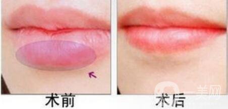 厚唇改薄,厚唇改薄多久見*,厚唇改薄圖