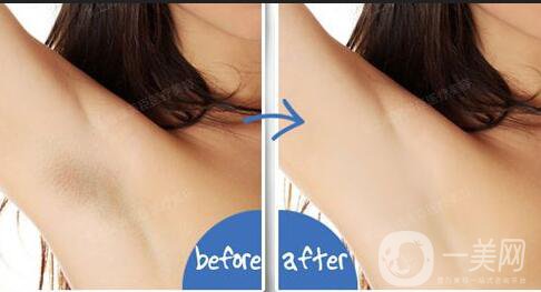 激光脫毛,激光脫毛危害