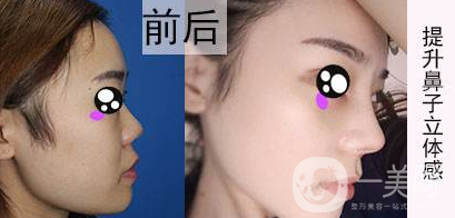 北京肋軟骨隆鼻價格一般是多少