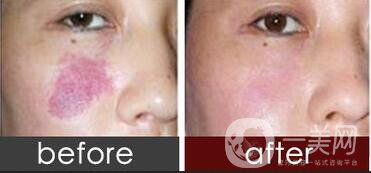 激光去胎記,激光去胎記注意事項(xiàng)