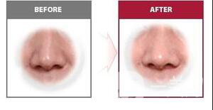 深圳歪鼻矯正多少錢