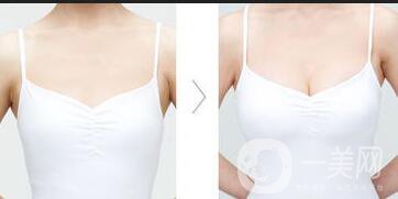 北京脂肪豐胸手術(shù)多少錢