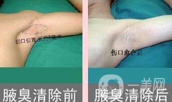 注射去狐臭,注射去狐臭維持時間