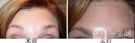 自體脂肪去抬頭紋多少錢