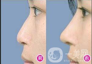 深圳自體隆鼻多少錢