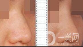 上海自體組織隆鼻價(jià)格