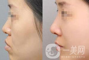 廣東豐面頰多少錢