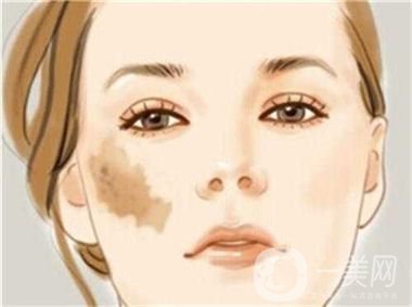 激光去咖啡斑恢復(fù)過程