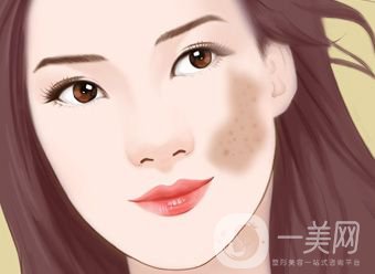 激光去咖啡斑恢復(fù)過程