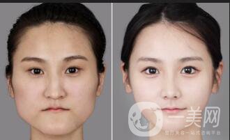 上海下頜角手術(shù)價格