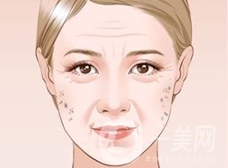 激光去老年斑需要幾次