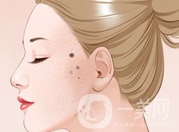 激光祛痣術(shù)后護理