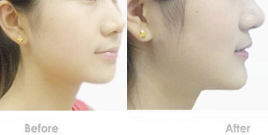 深圳墊下巴費(fèi)用