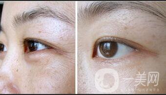 眼部熱瑪吉注意事項(xiàng)