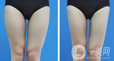 上海吸脂瘦大腿多少錢