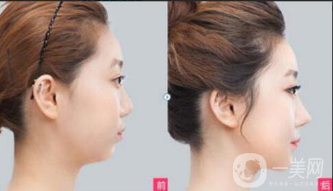 北京自體軟骨墊鼻多少錢