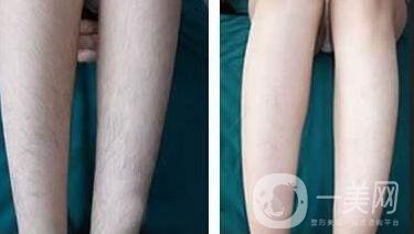 激光脫毛*果,激光脫毛*果維持多久