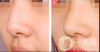 深圳駝峰鼻矯正術(shù)多少錢