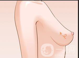 深圳取出隆胸假體多少錢