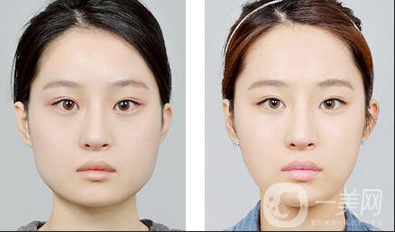 北京墊下巴多少錢