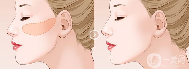 北京顴骨顴弓整形多少錢