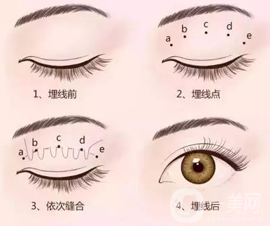 哪個割雙眼皮的方式比較好