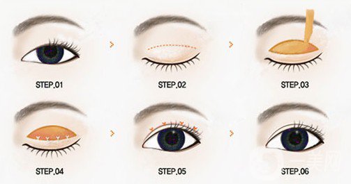 哪個割雙眼皮的方式比較好