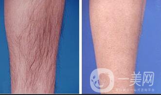 北京光子脫毛價格