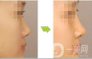 北京朝天鼻矯正多少錢(qián)