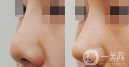 上海朝天鼻矯正價格