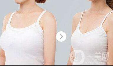 廣東胸部縮小術多少錢